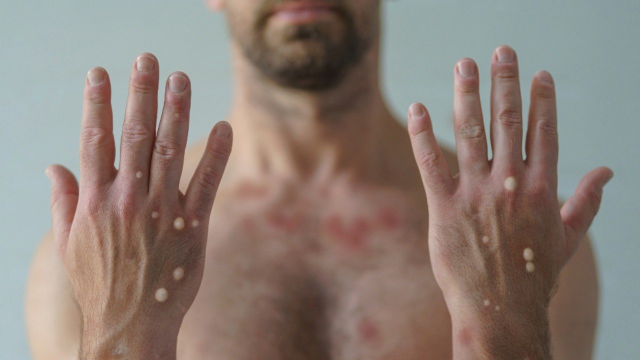 Casos de Mpox no Brasil atingem 88 confirmações em 2026; Ceará continua sem nenhum registro