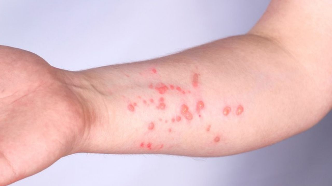 Ceará confirma terceiro caso de Mpox em 2026; estado tem 29 notificações ao todo