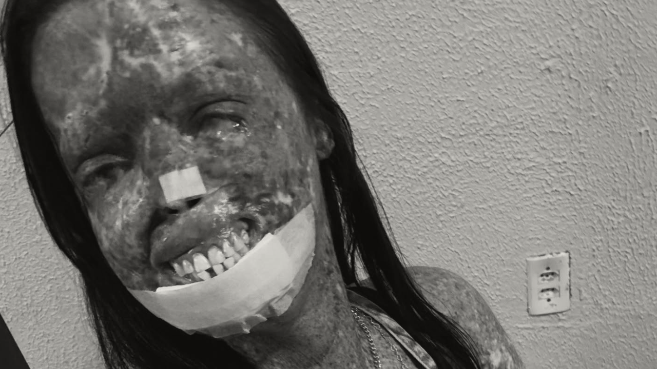 Criadora de conteúdo enfrentava o xeroderma pigmentoso, condição que aumenta o risco de câncer de pele. Morte foi anunciada pela família nas redes sociais nesta sexta-feira (24)